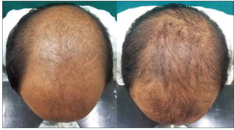 Regain Confidence with Topical Finasteride Treatment