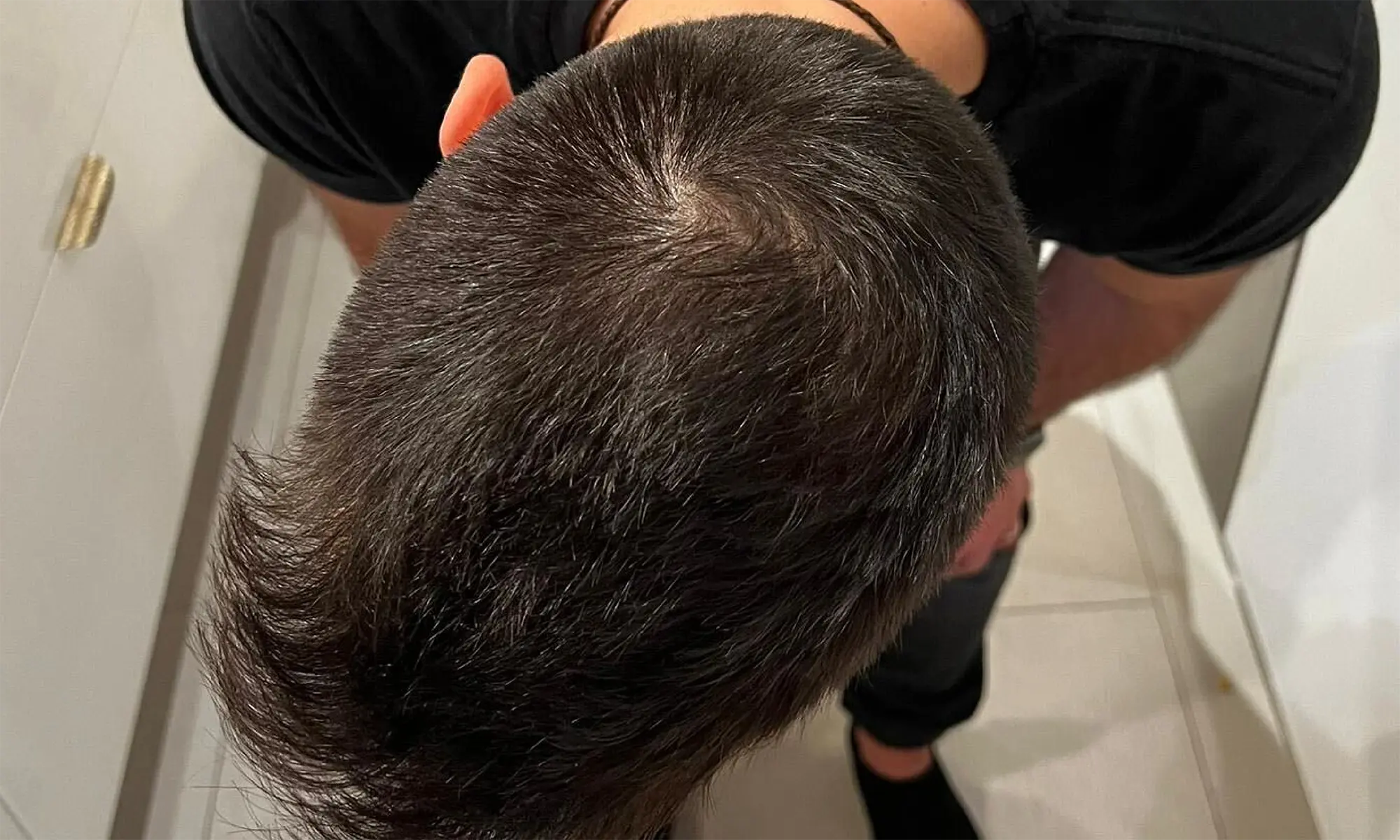 topical finasteride